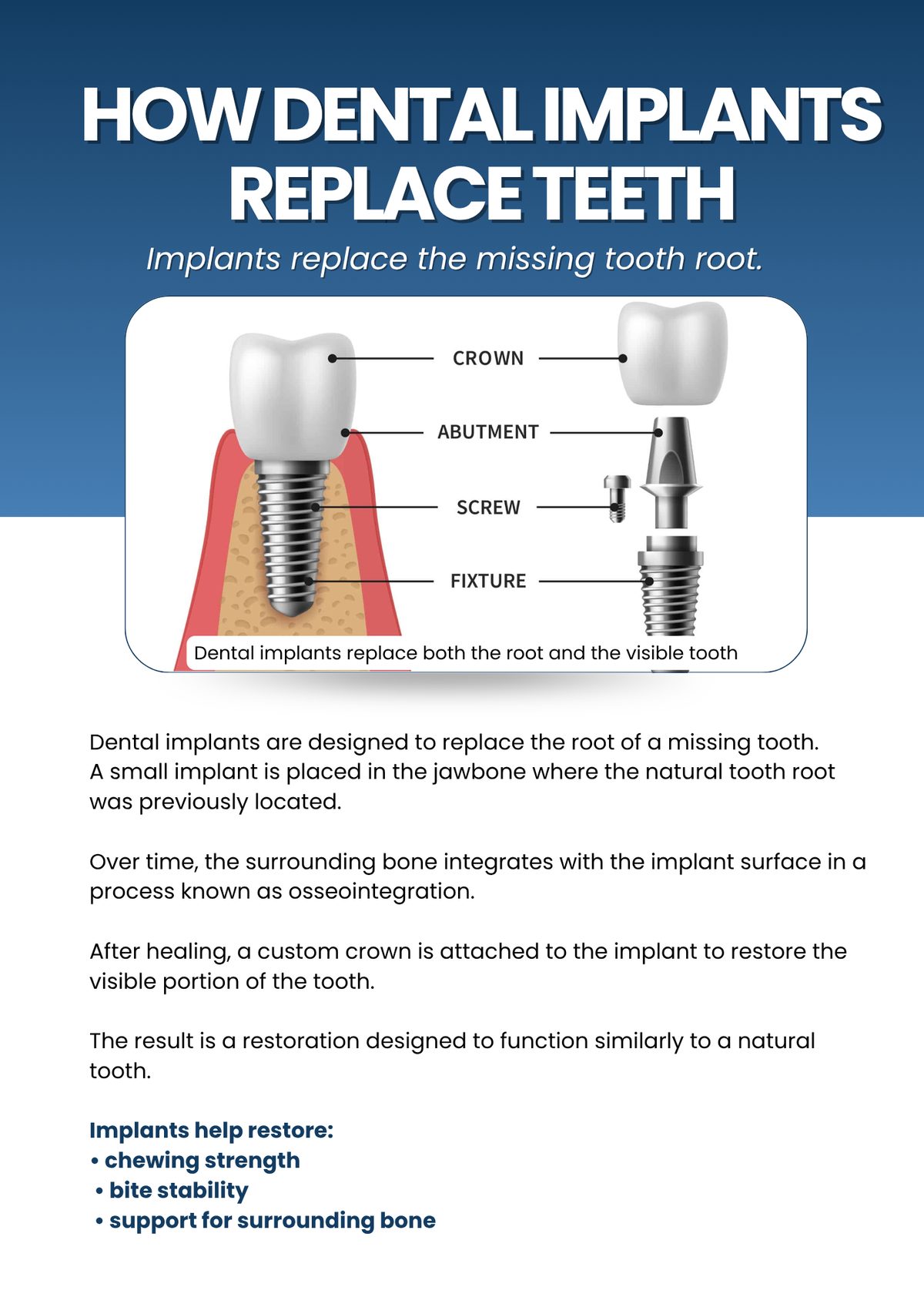 Dental implant anatomy showing crown, abutment, screw, and fixture