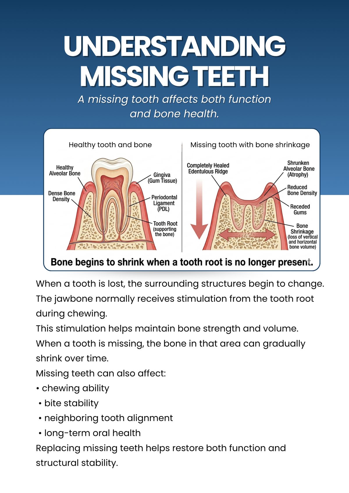 Healthy tooth vs. missing tooth showing bone shrinkage over time